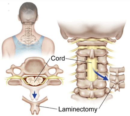 Cervical Spine Cord Laminectomy